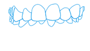 Show deep overbite malocclusion